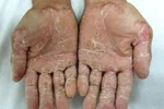 Quảng Ngãi: Đã có phác đồ điều trị "bệnh lạ" 