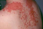 Dị ứng thực phẩm: Làm sao để "tóm" bệnh? 