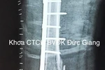 Cứu sống bệnh nhân gãy xương, tổn thương phức tạp động mạch đùi