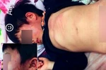 Học sinh 3 tuổi trường Ngọc Sơn bị đánh bầm tím ở lớp học