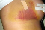Biết đau đớn thế, tôi đã không dám đi nâng "vòng 1"