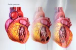 Cách kiểm soát bệnh cao huyết áp không cần dùng thuốc 