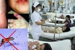 Bệnh tay chân miệng, sốt xuất huyết dễ "tấn công" trẻ trong tháng 8