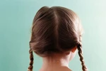 Bé 5 tuổi bị tắc dạ dày vì... ăn tóc 