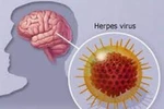 Viêm não virus, phòng bệnh bằng cách nào?