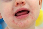 Những biến chứng nguy hiểm của bệnh tay chân miệng