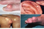 Bệnh gout, không nên ăn gì?