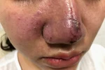 Mù mắt, biến dạng mặt vì tiêm filler trôi nổi, lời cảnh tỉnh cho chị em