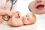 Bộ Y tế yêu cầu tăng cường phòng chống dịch chân tay miệng