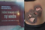 Nam sinh lớp 9 THCS Tự Nhiên, Thường Tín bỏng nặng do bị bạn "giác hơi" 