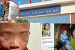 Sau khi trường phun thuốc muỗi, nhiều học sinh TH Hải Bối mẩn ngứa, rát mắt 