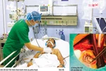 Cứu sống bệnh nhân thủng vách liên thất rất lớn do nhồi máu cơ tim