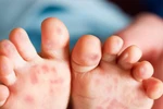 Đã có hơn 53.000 trường hợp mắc bệnh chân tay miệng