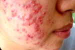 Xài mỹ phẩm trôi nổi, nhiều người "tiền mất, tật mang"