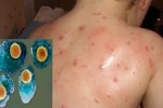 Đề phòng tổn thương mắt do thủy đậu và sởi