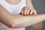Làm cách để khỏi phát ban nhanh nhất?