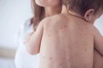 Chăm sóc trẻ mắc bệnh sởi