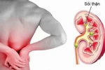 5 dấu hiệu cảnh báo về sỏi thận mà bạn cần biết