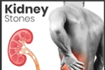 Sỏi thận gây ra cảm giác đau đớn, ảnh hưởng xấu đến sức khoẻ