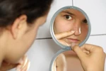 6 cách hay giảm nhanh mụn nội tiết tố
