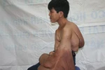 "Dị nhân" có cánh tay khổng lồ ở Kiên Giang