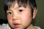 Trẻ hơn 2 tuổi bị cô giáo đánh thâm tím mặt