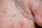Bộ Y tế cảnh báo bệnh tay chân miệng
