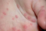 Bộ Y tế cảnh báo bệnh tay chân miệng
