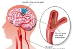 Phương pháp mới hỗ trợ điều trị thiểu năng tuần hoàn não 
