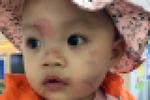 Ngày đầu đến trường, bé gái 14 tháng tuổi bị nhiều vết thương trên mặt