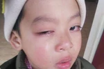 Phụ huynh kêu cứu vì nghi con mình bị cô giáo dùng thước kẻ đánh vào mắt