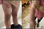 Hải Phòng: Xác minh thông tin học sinh lớp 2 bị bố dượng đánh bầm tím khắp người