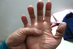 Điều trị bệnh cước bằng những bài thuốc đơn giản