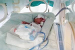 Sinh non, bé bị thủng dạ dày bẩm sinh