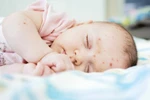 11 bài thuốc trị mụn nhọt cho trẻ nhỏ
