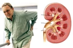 Những biến chứng nguy hiểm của bệnh sỏi thận