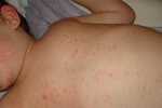 5 bước chăm sóc đúng cách trẻ sốt phát ban tại nhà 