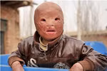 Cậu bé có gương mặt bị đốt cháy đáng thương ở Trung Quốc