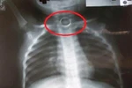Bé 2 tuổi tử vong do bị ngạt dị vật ở nhóm trẻ tư thục tại Đồng Nai