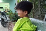 Cảnh cáo cô giáo đánh học sinh khuyết tật bầm tím
