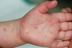 Cảnh báo dịch bệnh tay chân miệng vào mùa gây nguy hiểm cho trẻ nhỏ 