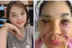 Nguy cơ tai biến nặng khi làm đẹp bằng mỡ tự thân