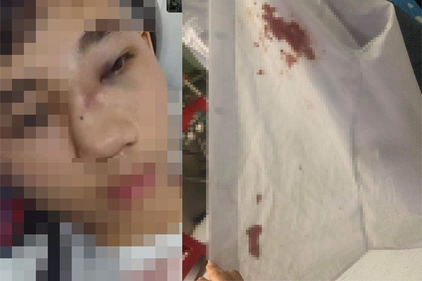 Hình ảnh nam sinh N.T.T. (học sinh lớp 10 A4, trường Trung học phổ thông số 3 An Nhơn) bị thương tích nặng sau khi bị nhóm bạn lớp 10A5 hành hung. (Ảnh người trong gia đình chia sẻ trên mạng xã hội) Hình ảnh nam sinh N.T.T. (học sinh lớp 10 A4, trường Trung học phổ thông số 3 An Nhơn) bị thương tích nặng sau khi bị nhóm bạn lớp 10A5 hành hung. (Ảnh người trong gia đình chia sẻ trên mạng xã hội)