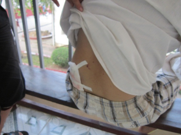 Một vế thương ở phần lưng của anh Nguyên.