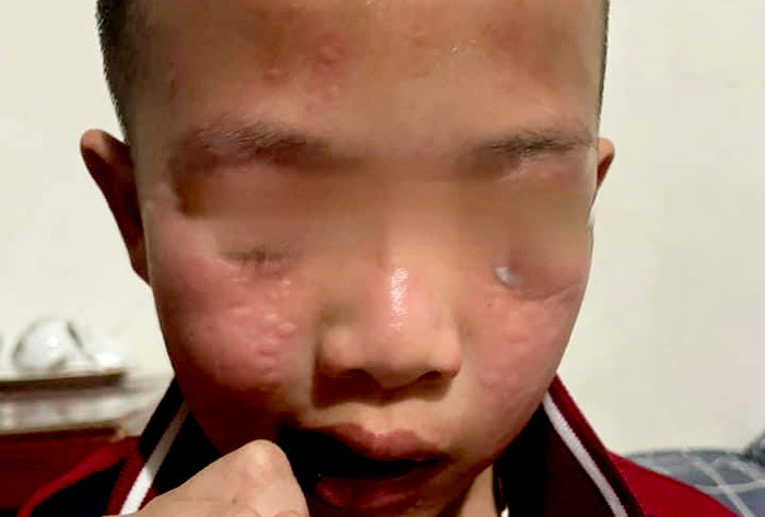 Có nhiều em bị dị ứng nổi mề đay, chảy máu cam. (Ảnh: Phụ huynh cung cấp) gdvn_th-hai-boi (2).jpg