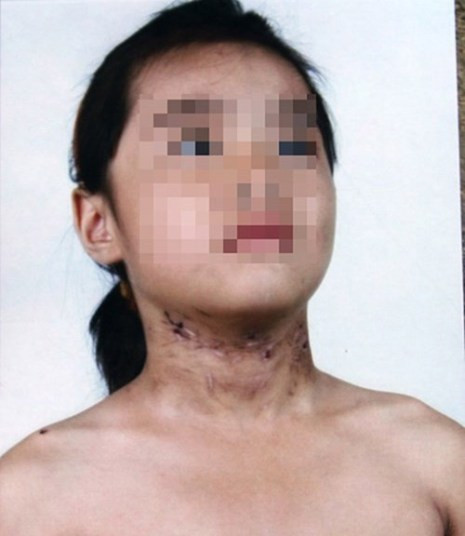 Cháu Nguyễn Minh T. (Hải Dương) với những vết thương trên người sau nhiều ngày bị bố và mẹ kế hành hạ. Cháu Nguyễn Minh T. (Hải Dương) với những vết thương trên người sau nhiều ngày bị bố và mẹ kế hành hạ.