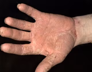 Những bài thuốc dân gian phòng và điều trị á sừng hiệu quả