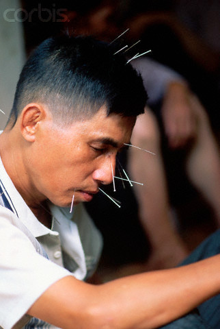 Châm cứu - một phương pháp trị bệnh độc đáo được áp dụng tại một phòng khám Đông y. Châm cứu - một phương pháp trị bệnh độc đáo được áp dụng tại một phòng khám Đông y.