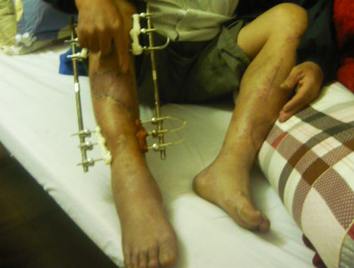 Cú tông như trời giáng của quái xế khiến Trung tá Cường bị gãy cả hai chân. Vết sẹo chi chít trên hai đôi chân. Cú tông như trời giáng của quái xế khiến Trung tá Cường bị gãy cả hai chân. Vết sẹo chi chít trên hai đôi chân.