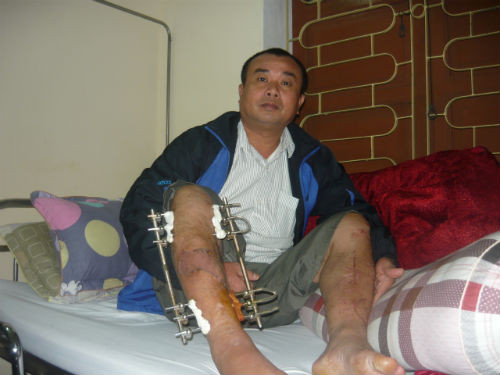 Chân dung vị CSGT hai lần bị "quái xế" tông gãy tay, chân. Chân dung vị CSGT hai lần bị "quái xế" tông gãy tay, chân.